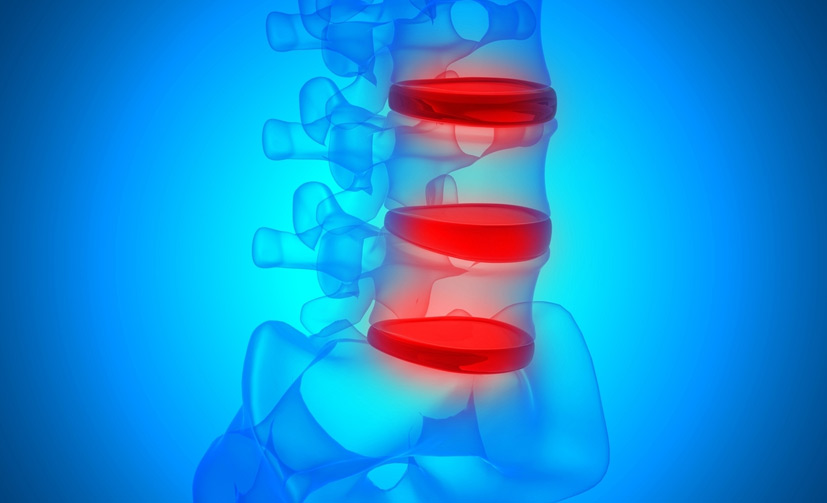 DIscectomy-1