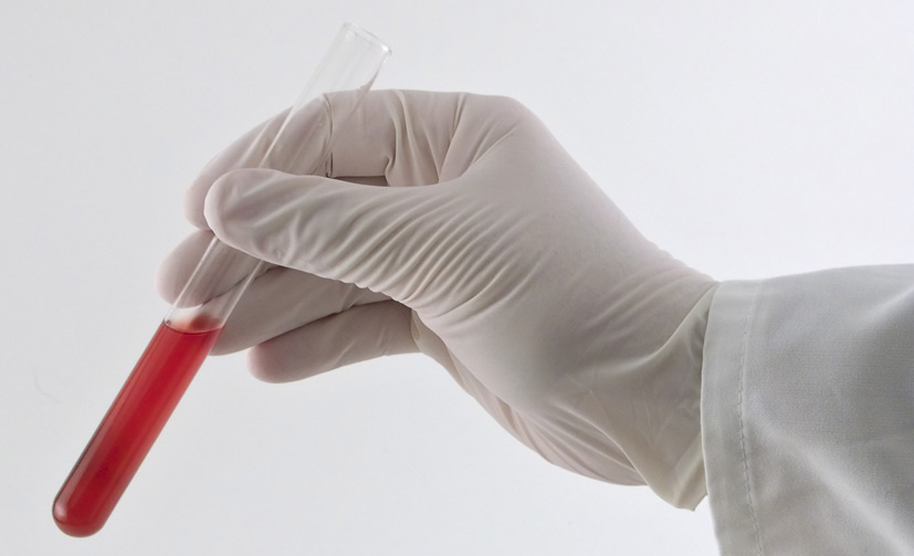 Platelet-Rich-Plasma-1