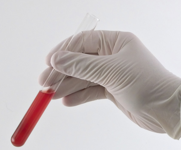 Platelet Rich Plasma