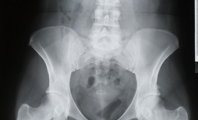 Sacroiliac-Joint-Injections-2