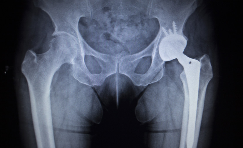 Total-Joint-Replacement-1