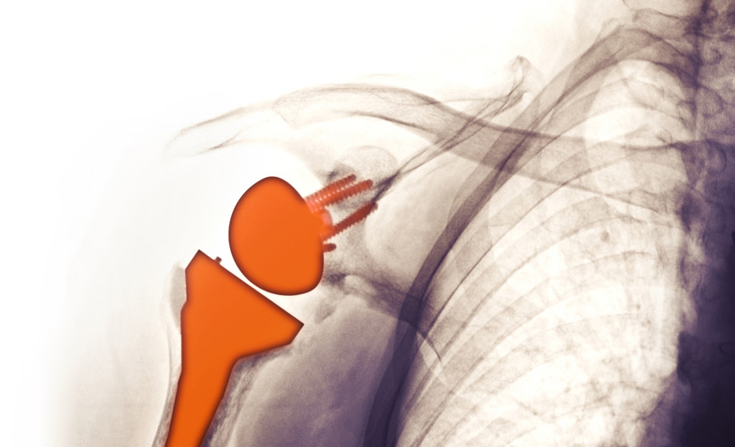 Total-Joint-Replacement-2
